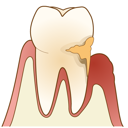 歯周病