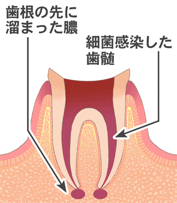 歯根治療