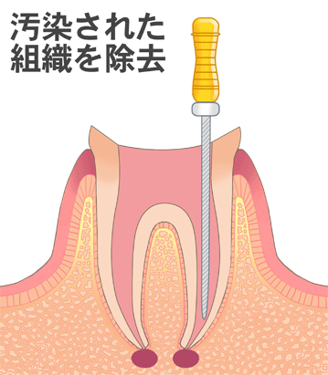 歯根治療