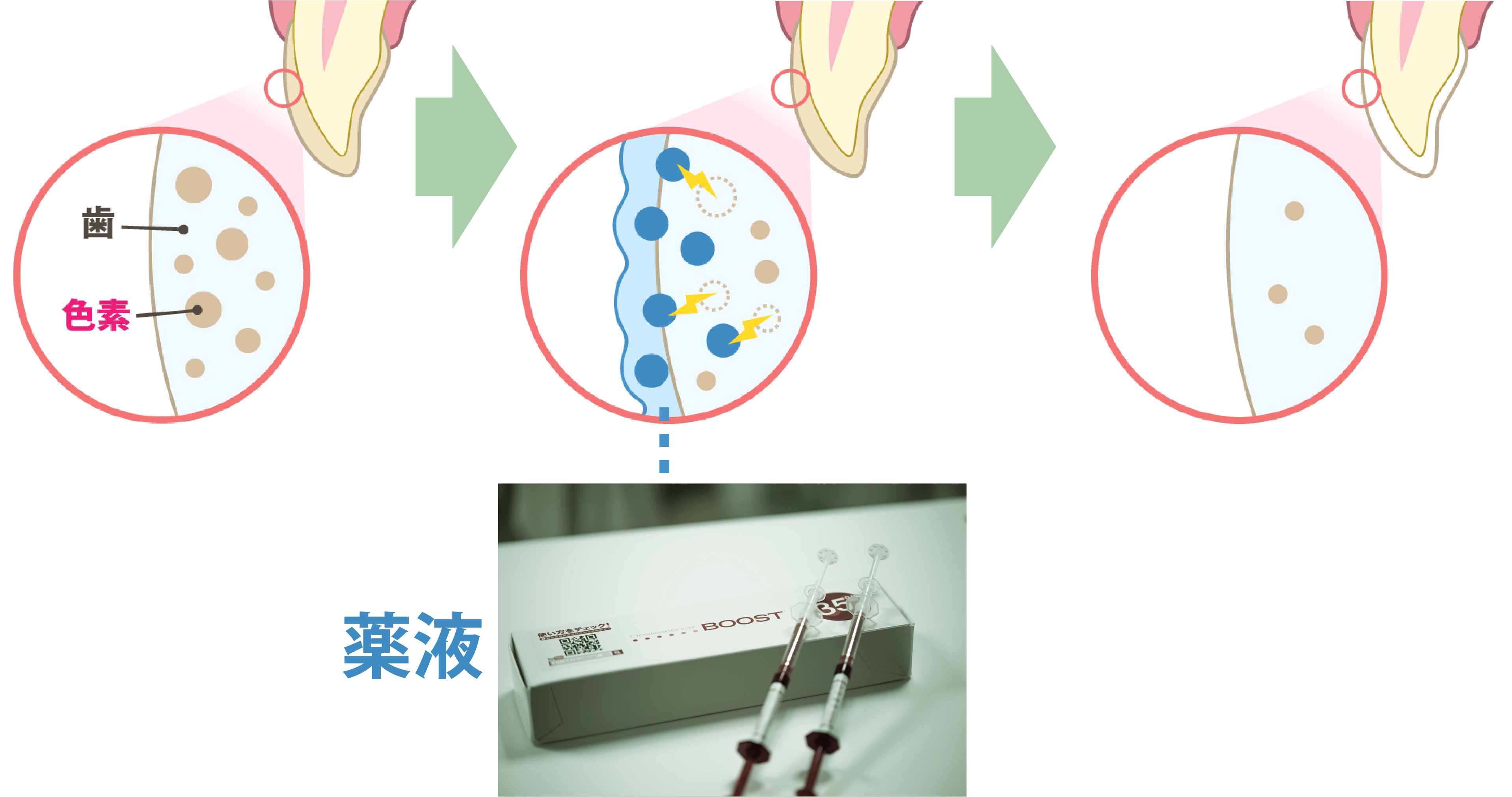 ホワイトニング